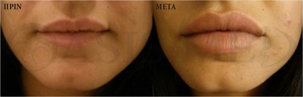 before after 0