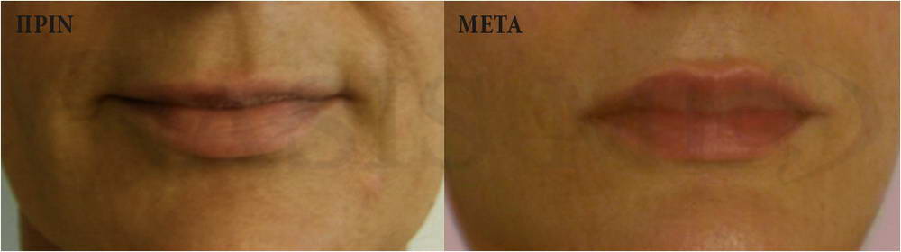 before after 9