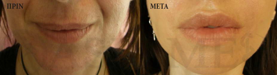 before after 1