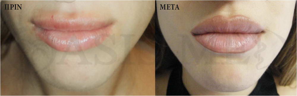 before after 2