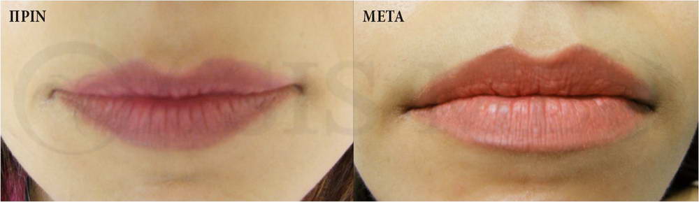 before after 4