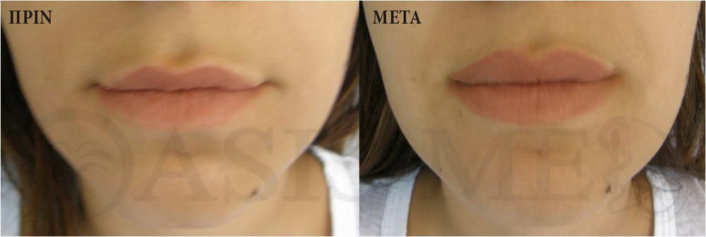 before after 5
