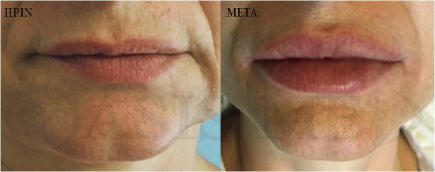 before after 6