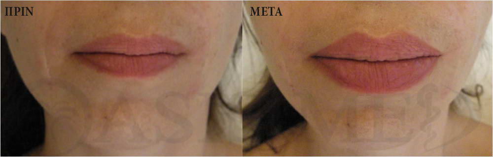 before after 8