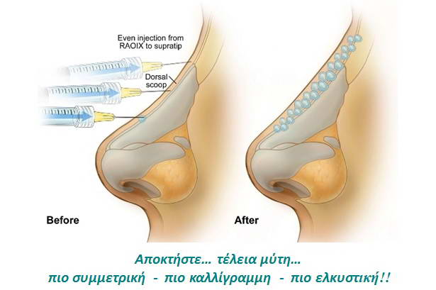 Μη Επεμβατική Ρινοπλαστική 4