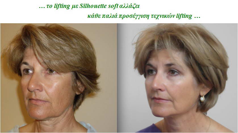 Lifting με Νήματα 5