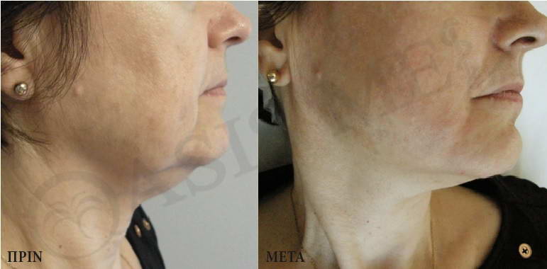 before after 9
