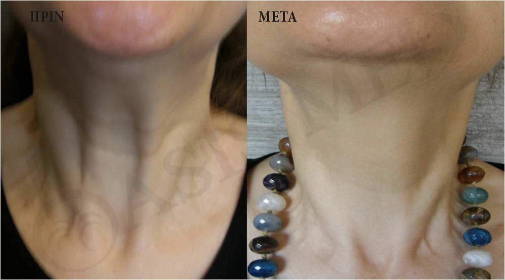 before after 2