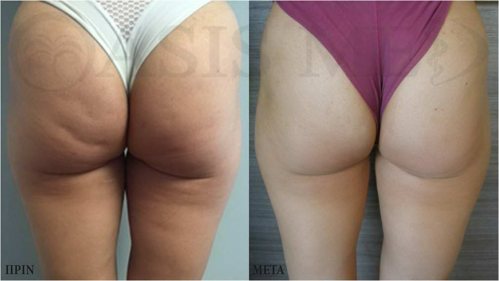 before after 0