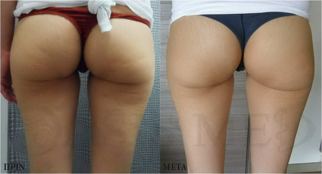 before after 1