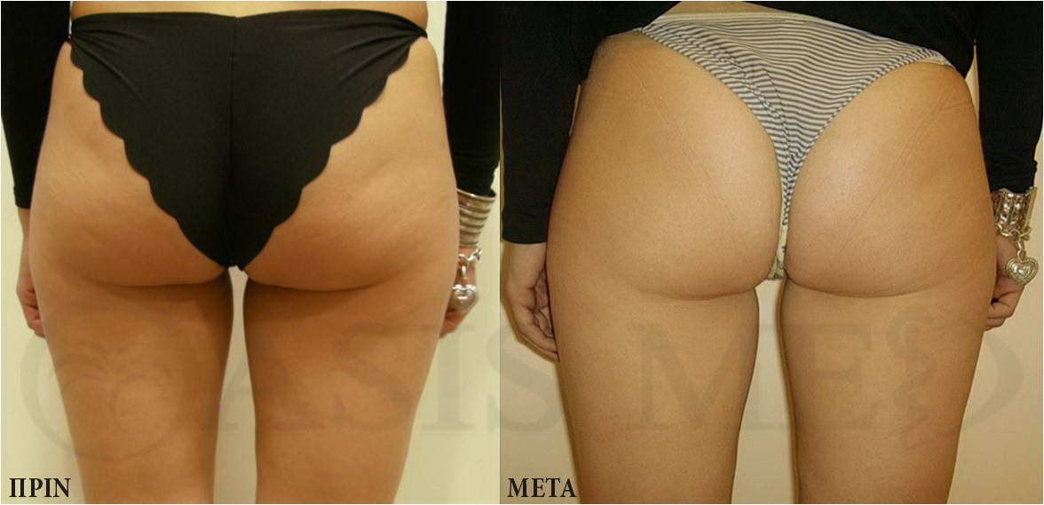before after 2