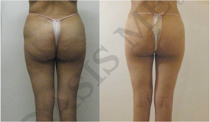 before after 4