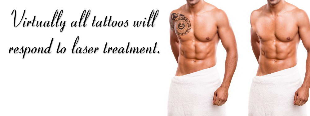 Αφαίρεση Ανεπιθύμητων Tattoo 11