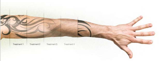 Αφαίρεση Ανεπιθύμητων Tattoo 14