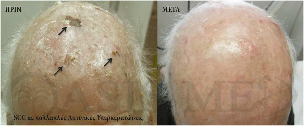 before after 0