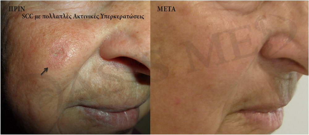 before after 1