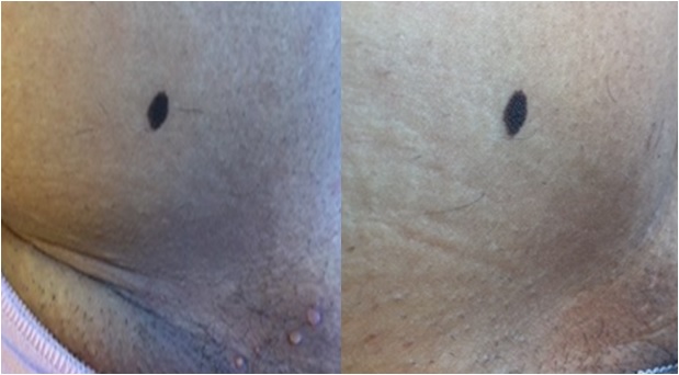 before after 0