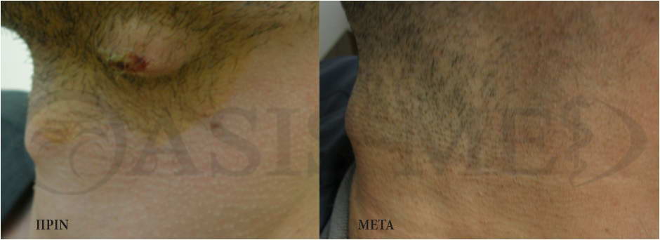 before after 0