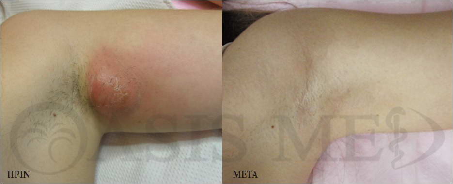 before after 1