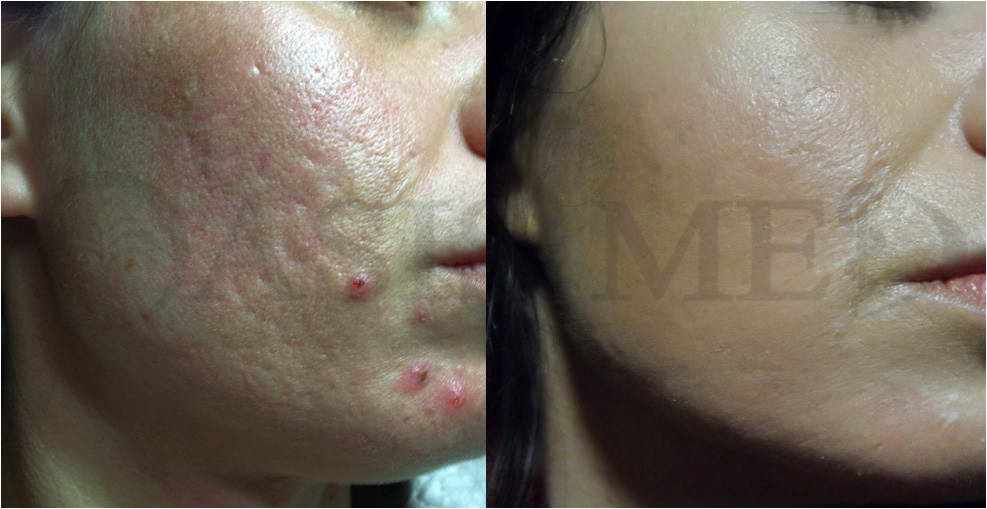 before after 26
