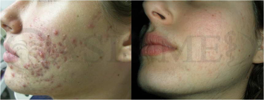 before after 35