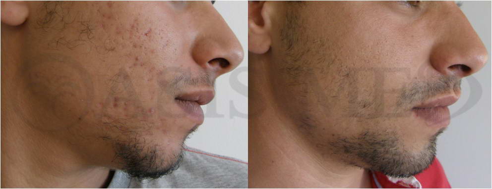before after 36
