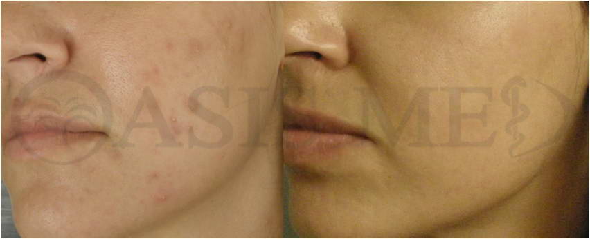 before after 37