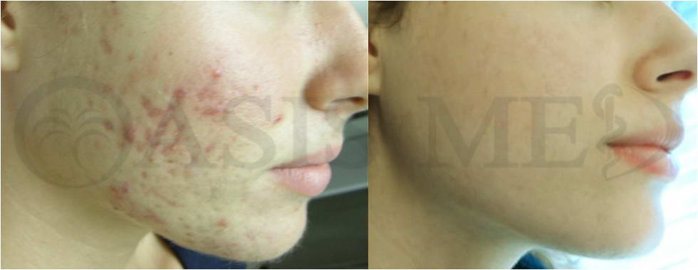 before after 38