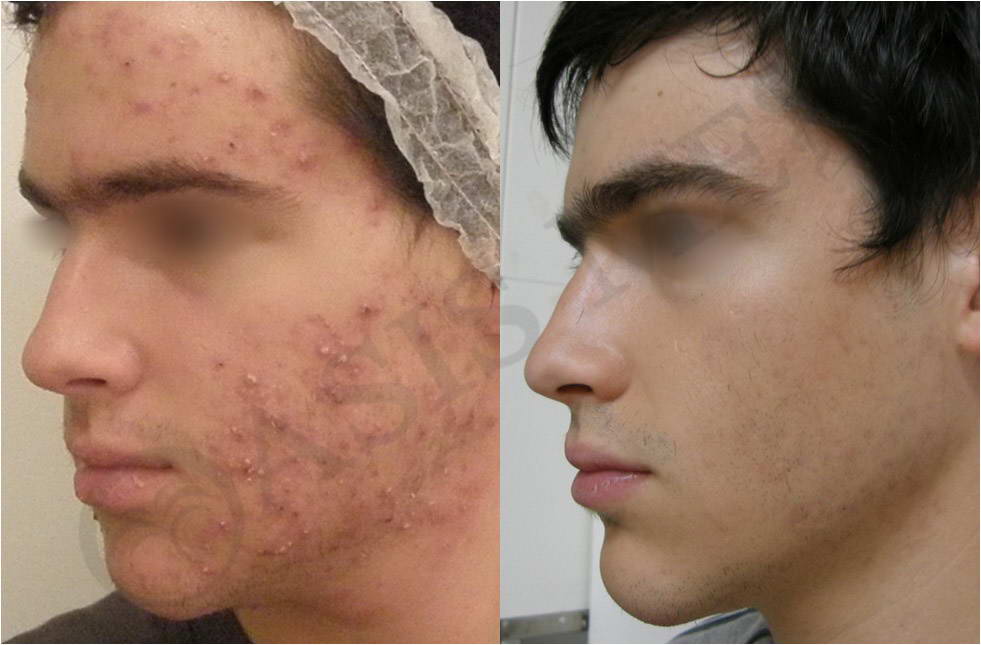 before after 39