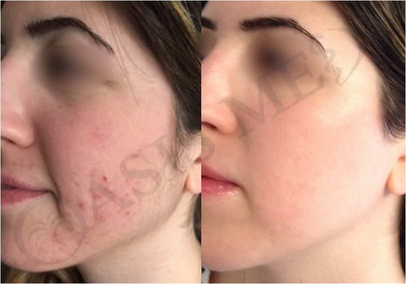 before after 40