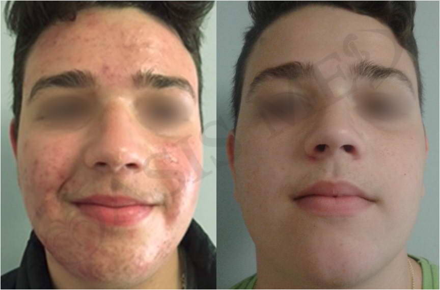 before after 41