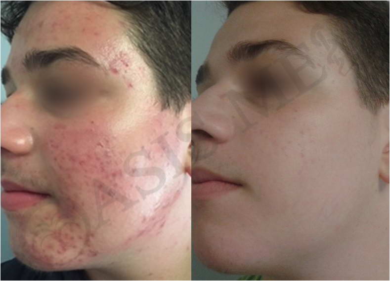 before after 42