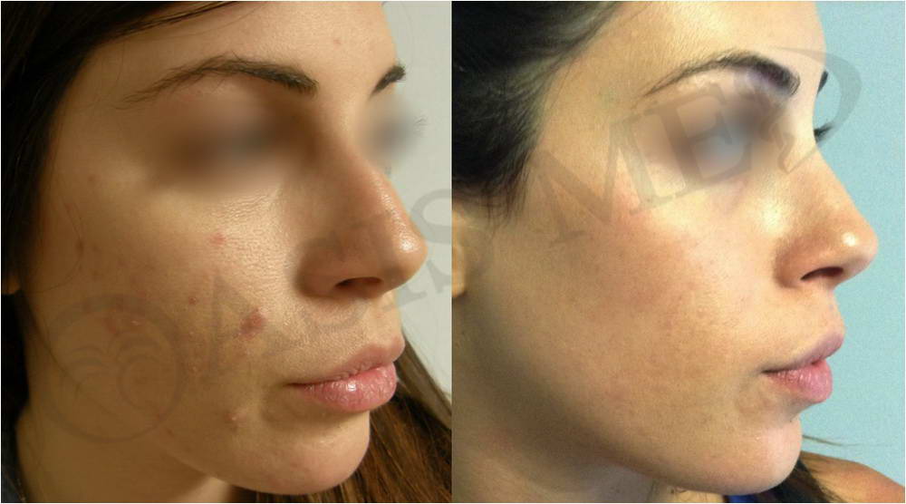 before after 43