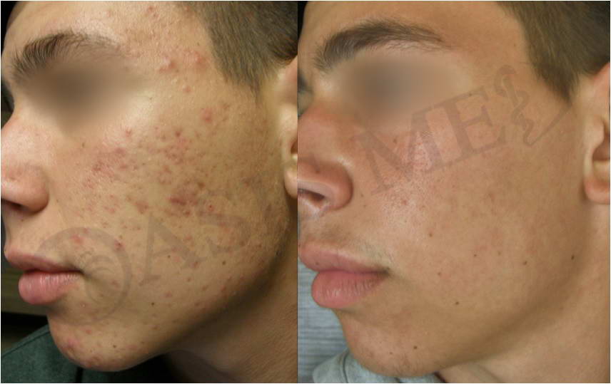 before after 28