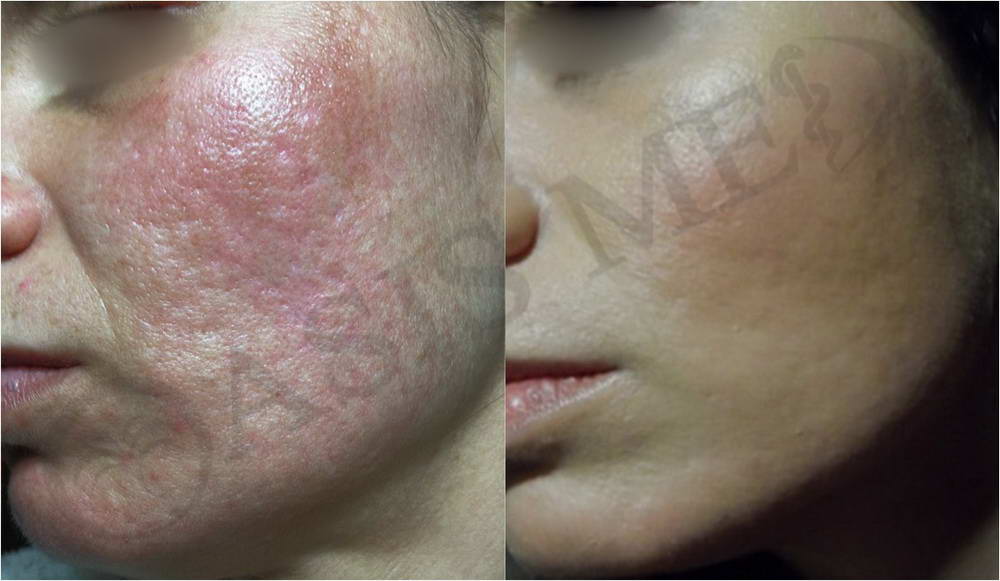 before after 30