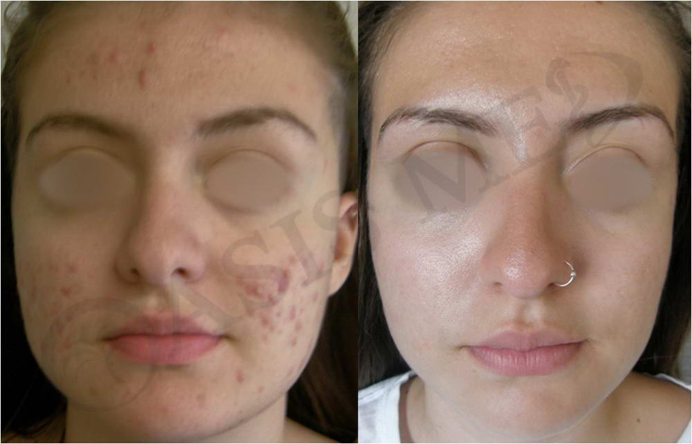 before after 31