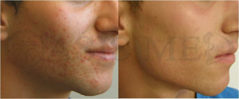 before after 32