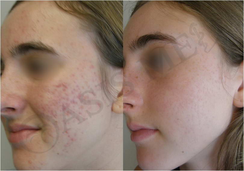 before after 33