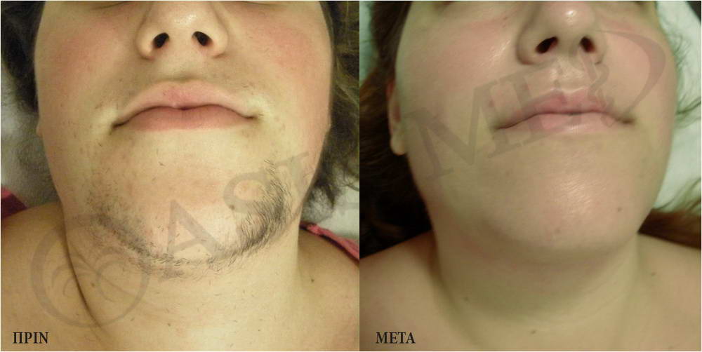 before after 5