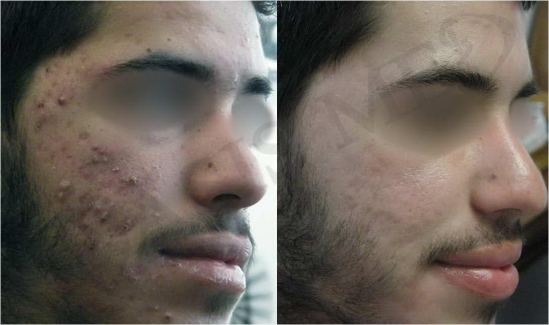 before after 9