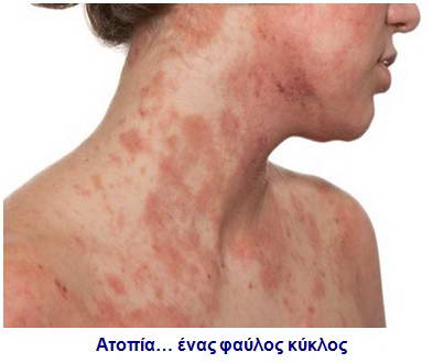 Ατοπική Δερματίτιδα – Έκζεμα 1