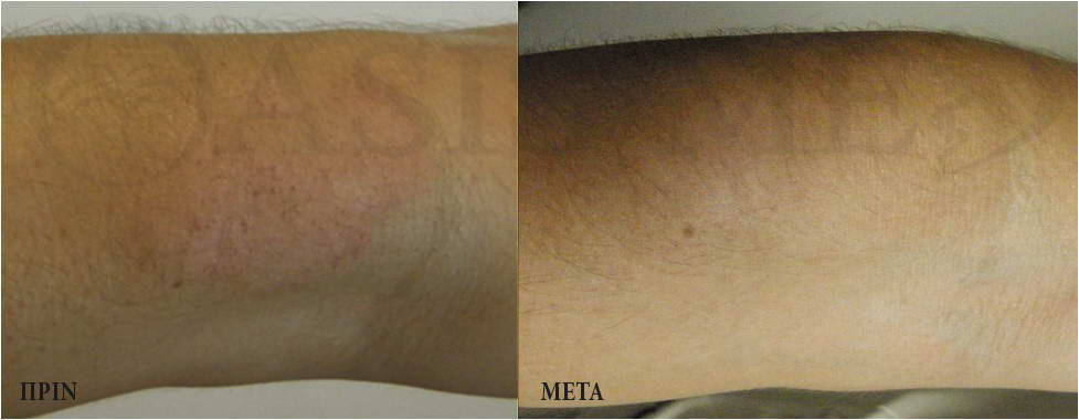 before after 5