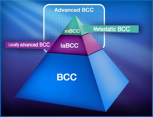 BCC (Βασικοκυτταρικό Καρκίνωμα) 11