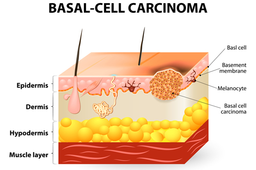 BCC (Βασικοκυτταρικό Καρκίνωμα)