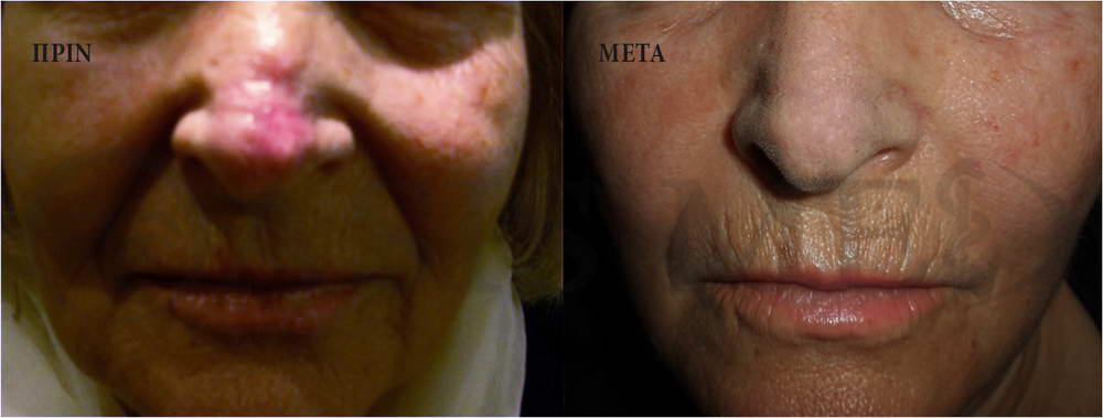 before after 1