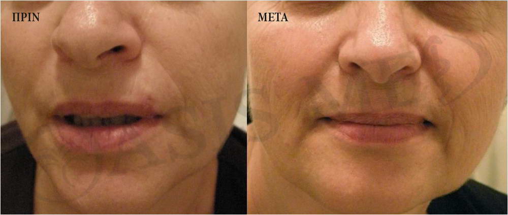 before after 5