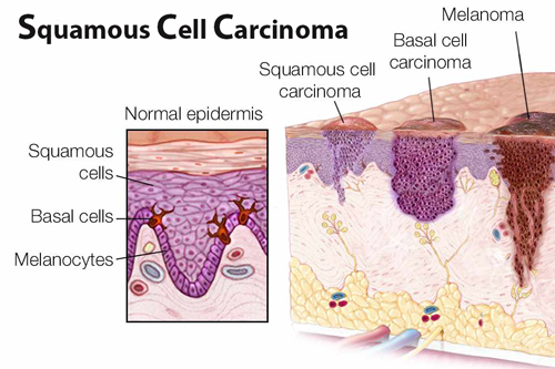 SCC (Ακανθοκυτταρικό Καρκίνωμα)