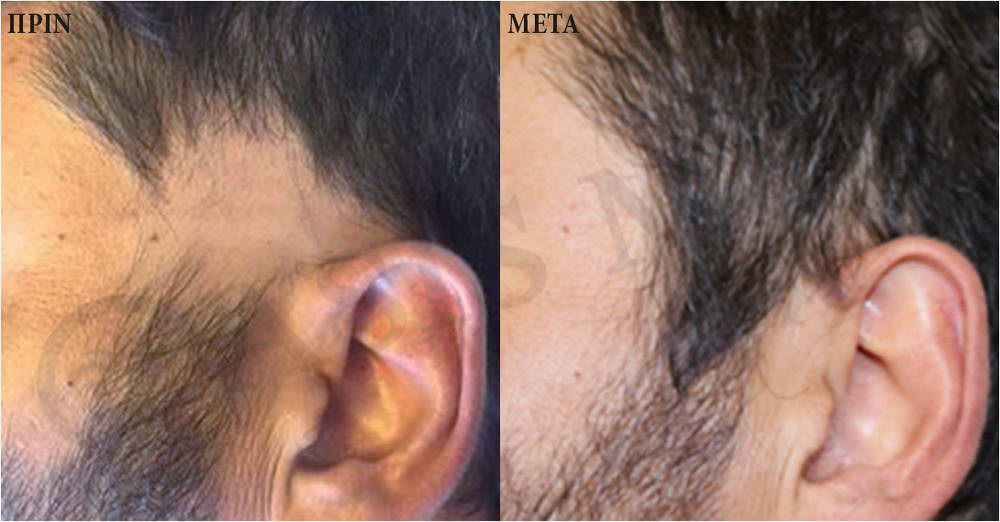 before after 0