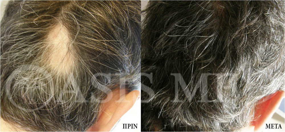 before after 1