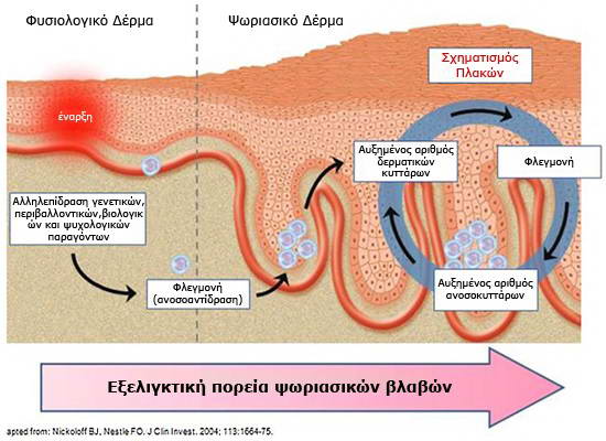 Ψωρίαση 1